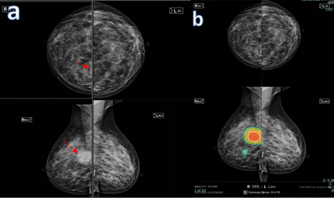 Мамографија и AI