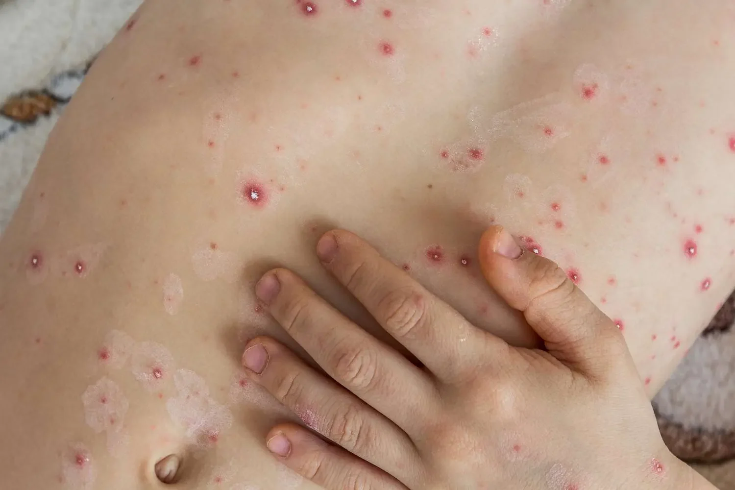 Majmunske boginje, osnosno virus MPOX