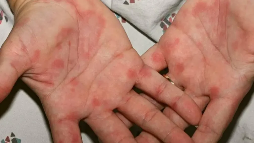 Црвени дланови