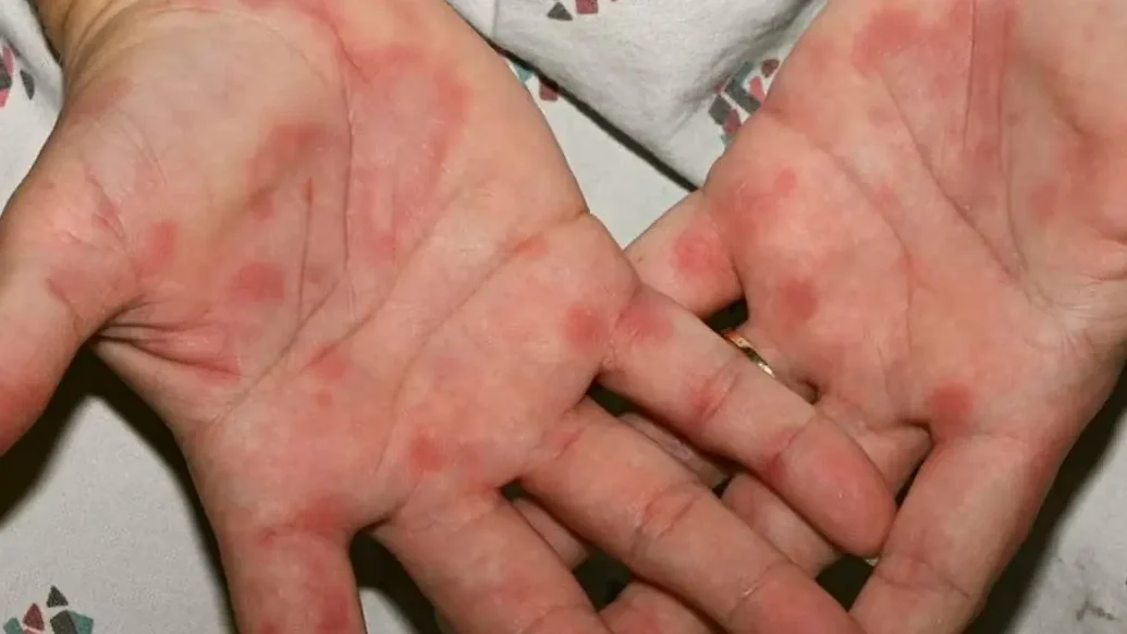 Црвени дланови