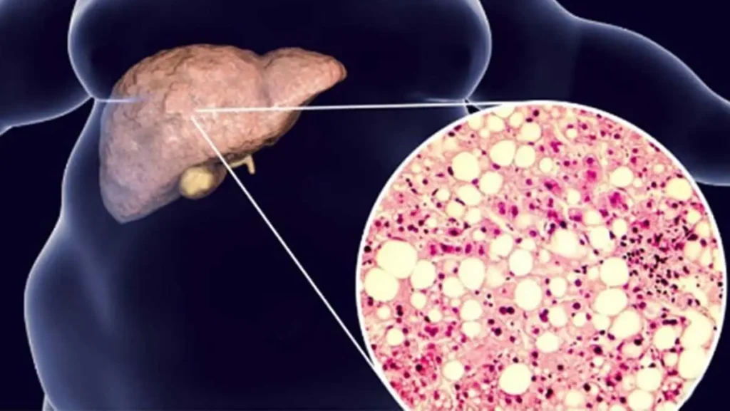 Масна јетра